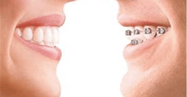 Why Are Braces So Expensive?